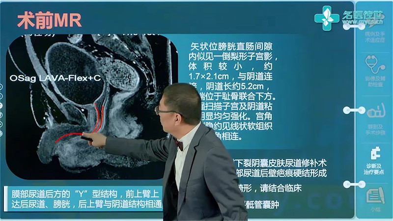 梁蔚波:导丝引导下尿道扩张 尿道内切除术治疗尿道狭窄